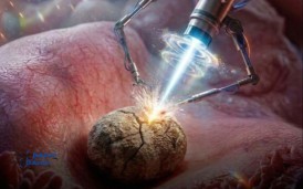 Böbrek Taşı Tedavisinde Devrim: Mikro Robotlar Ameliyat Dönemini Kapatıyor